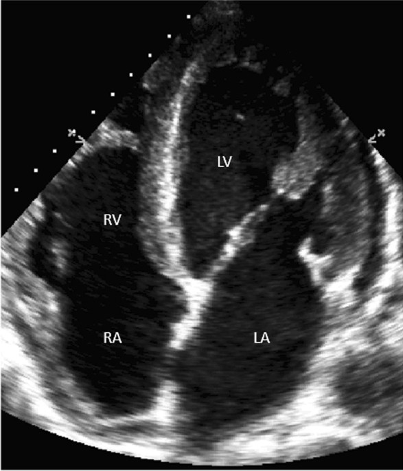 Figure, B-Mode ultrasound showing main portal] - StatPearls - NCBI  Bookshelf