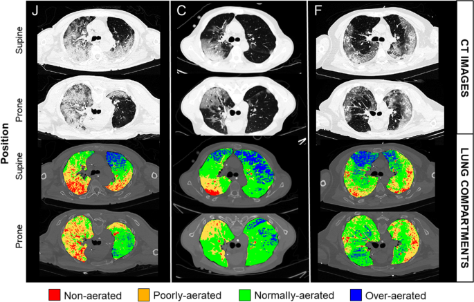 Benefits of prone positioning for mechanically ventilated patients 