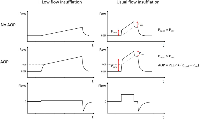 A novel method for assessment of airway opening pressure without the need  for low-flow insufflation | Critical Care | Full Text
