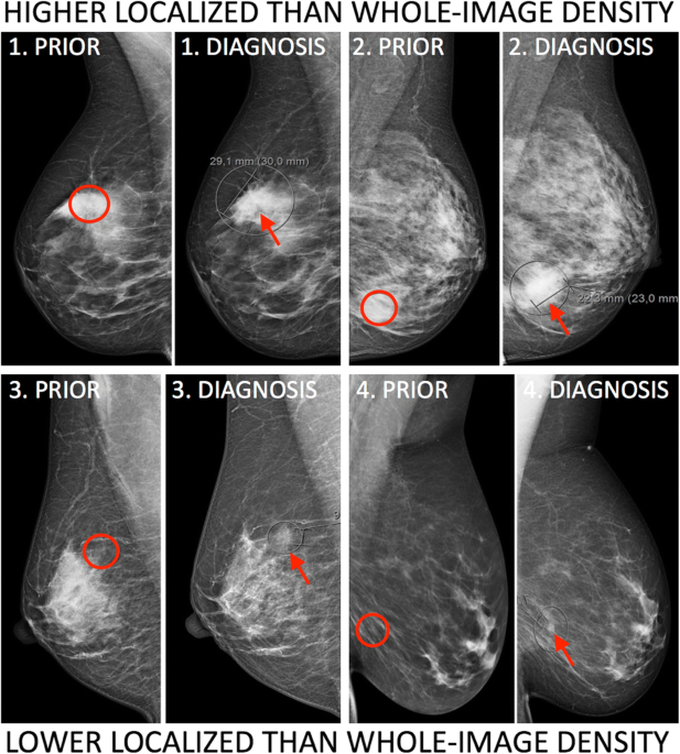Localized mammographic density is associated with interval cancer and large  breast cancer: a nested case-control study, Breast Cancer Research