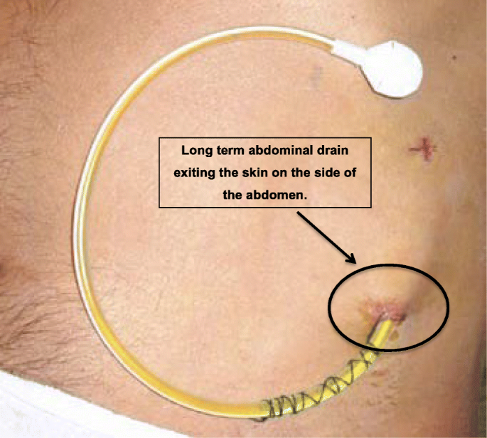 Palliative long-term abdominal drains versus repeated drainage in  individuals with untreatable ascites due to advanced cirrhosis: study  protocol for a feasibility randomised controlled trial | Trials | Full Text