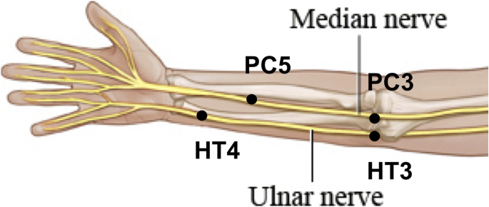 Bilateral Ulnar nerve palsies: an unusual complication of