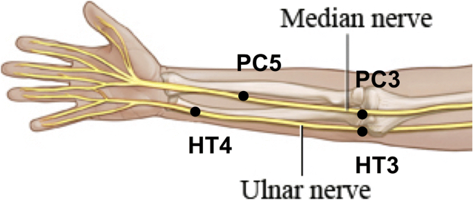 radial ulnar nerve bpc 157 Deep branch of Ulnar Nerve Dysfunction - UF