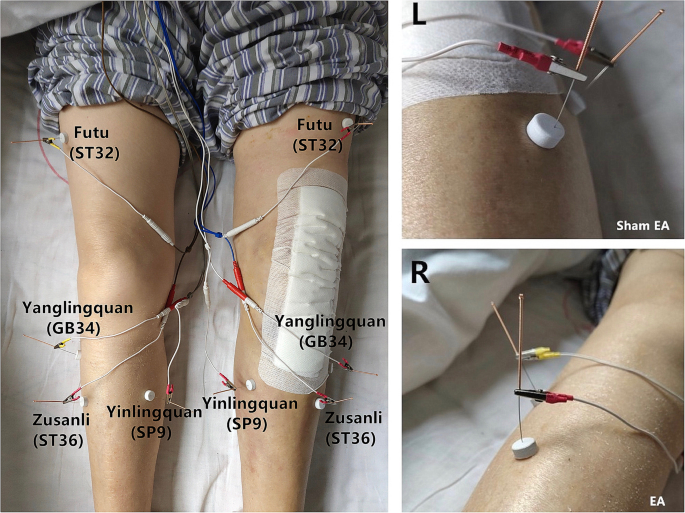 Opposing needling for analgesia and rehabilitation after unilateral total  knee arthroplasty: a randomized, sham-controlled trial protocol | Trials |  Full Text