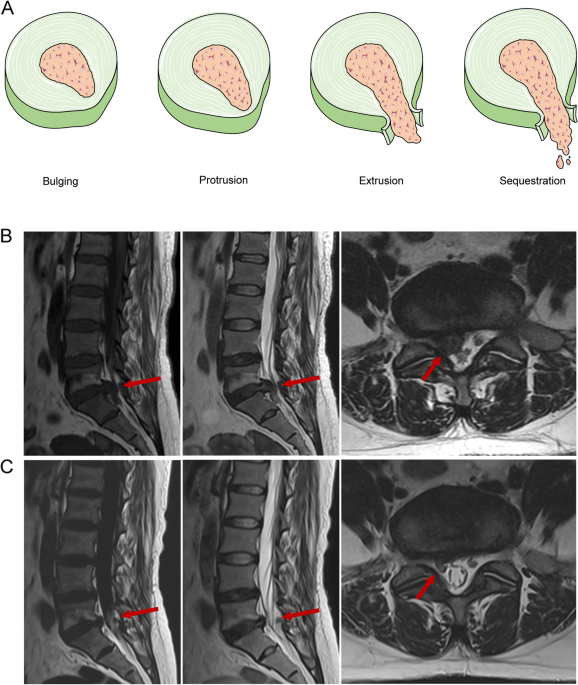 Characteristics and mechanisms of resorption in lumbar disc herniation |  Arthritis Research & Therapy | Full Text