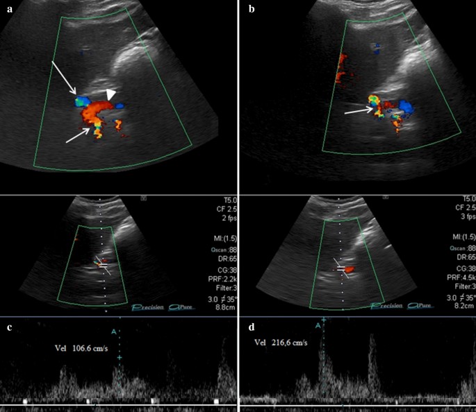 Figure, B-Mode ultrasound showing main portal] - StatPearls - NCBI  Bookshelf