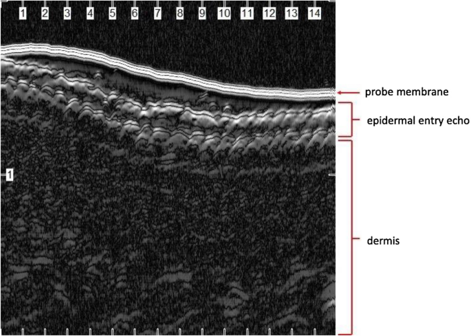 High-frequency ultrasound in clinical dermatology: a review, The Ultrasound  Journal