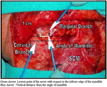 Preserving the marginal mandibular branch of the facial nerve during  submandibular region surgery: a cadaveric safety study, Patient Safety in  Surgery