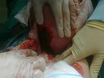 Hemoperitoneum caused by bleeding of adenomyosis: a case report