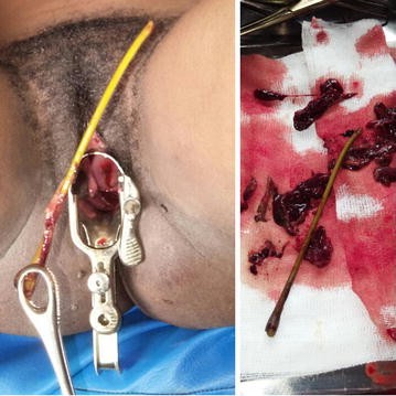 Cureus, Rupture of Unscarred Uterus With Intestinal Prolapse From Vagina  Following Criminal Abortion