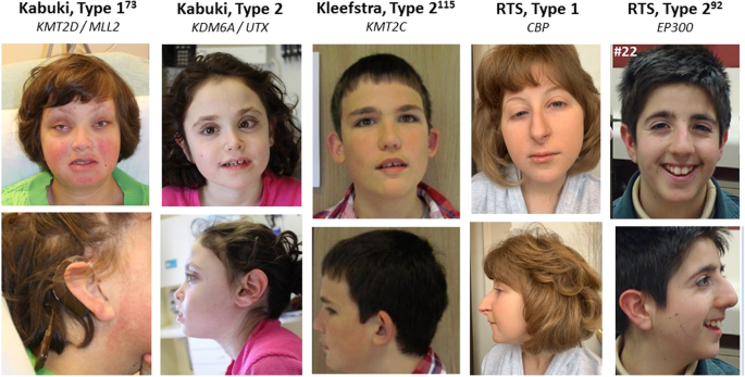 PDF) Prevalence of Immunological Defects in a Cohort of 97 Rubinstein–Taybi  Syndrome Patients
