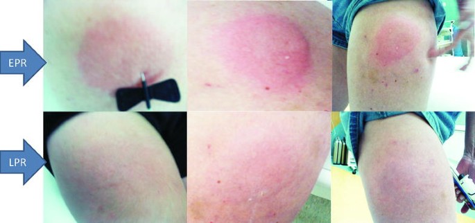 glutathione iv allergic reaction Passive blood anaphylaxis: subcutaneous immunoglobulins are a cause of  ongoing passive anaphylactic reaction | Allergy, Asthma & Clinical  Immunology