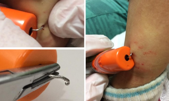 Hooked epinephrine auto-injector devices in children: four case reports  with three different proposed mechanisms | Allergy, Asthma & Clinical  Immunology | Full Text