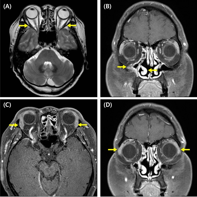 Long-term efficacy of anti-IL-4 receptor antibody in a patient with aspirin-exacerbated respiratory disease and IgG4-related disease