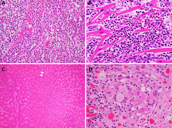 Fatal eosinophilic myocarditis and submassive hepatic necrosis in lamotrigine induced DRESS syndrome