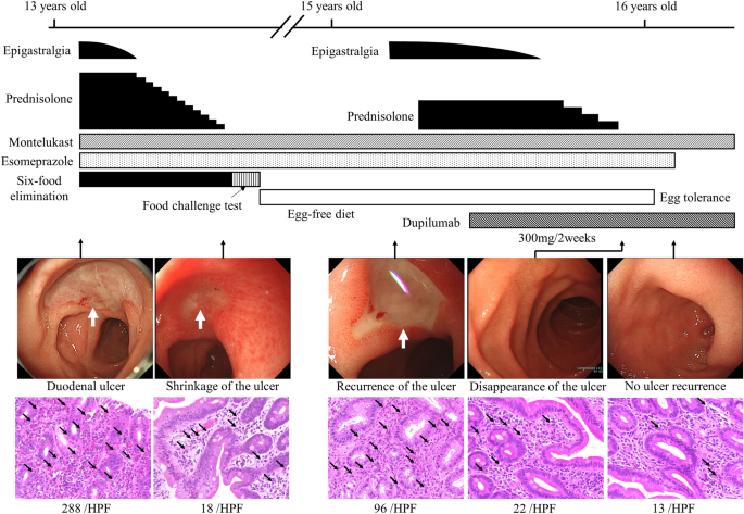 Successful use of dupilumab for egg-induced eosinophilic gastroenteritis with duodenal ulcer: a pediatric case report and review of literature