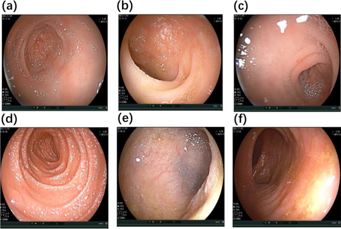 Eosinophilic gastritis and gluten-sensitive enteropathy manifested as hypoproteinemia and treated with omalizumab: a case report