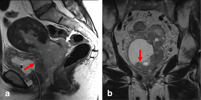 Role of MRI in staging and follow-up of endometrial and cervical cancer:  pitfalls and mimickers | Insights into Imaging | Full Text