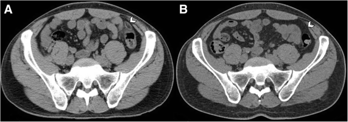Radiological manifestations of thoracic hydatid cysts: pulmonary and  extrapulmonary findings | Insights into Imaging | Full Text