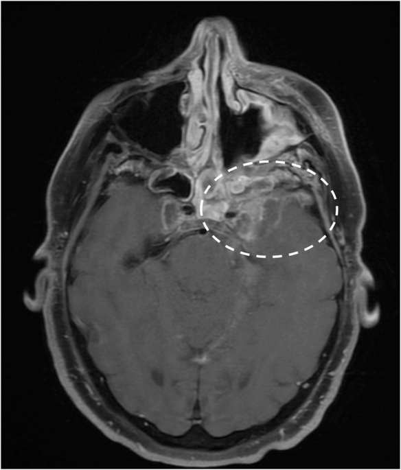 Inferior alveolar nerve, Radiology Reference Article