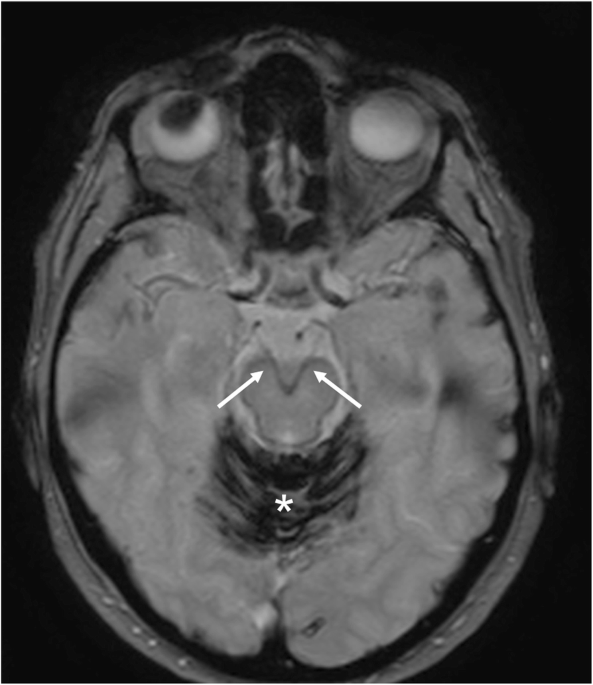 Inferior alveolar nerve, Radiology Reference Article