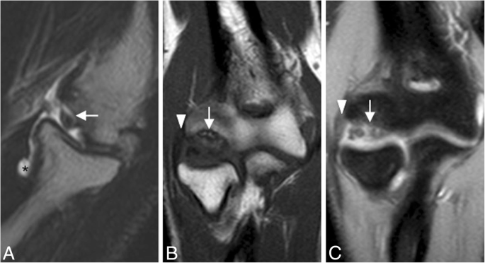 The elbow: review of anatomy and common collateral ligament complex  pathology using MRI, Insights into Imaging