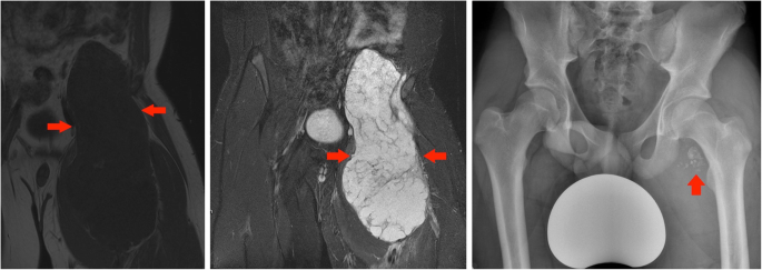 Muscle hernia in a 40-year-old man with a tender palpable mass at