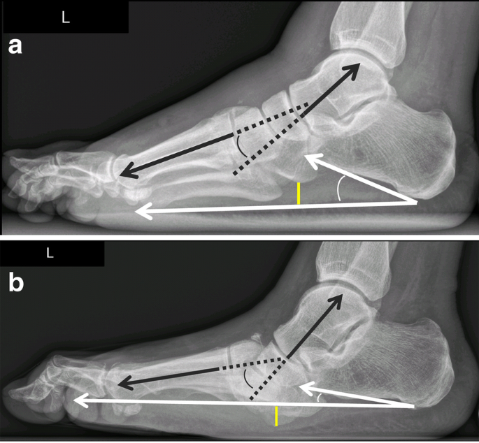 Lateral radiograph of the left tibia demonstrating the characteristic