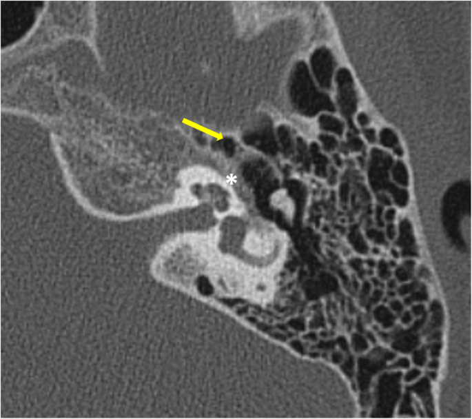 Stapes, Radiology Reference Article