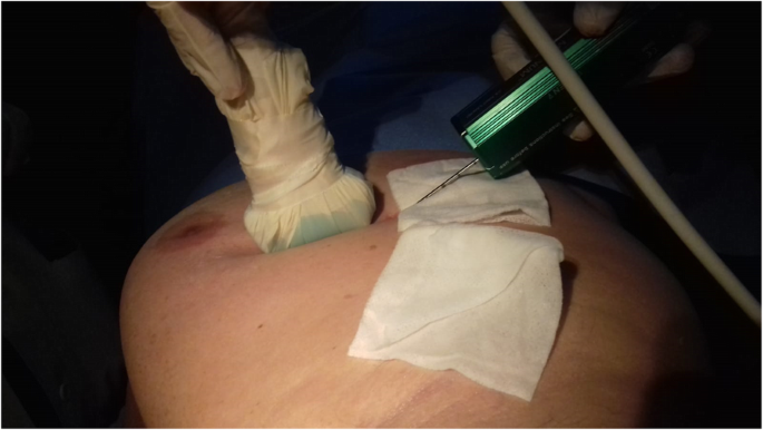 Clip migration after stereotactic vacuum-assisted breast biopsy with the  patient in the decubitus position