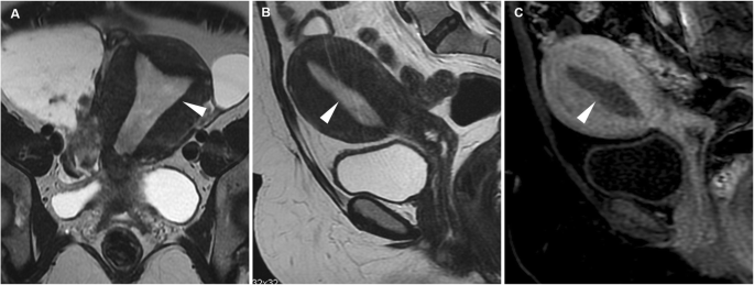 The diagnosis of diseases of women . Fig. 88.—Cervical polyp, possible to  mistake for an inverted fundus. The differentialdiagnosis is made by  passing a sound into the uterine cavity and by