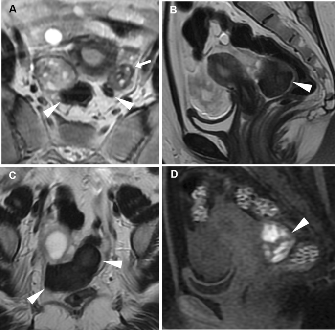 Cross-sectional imaging of acute gynaecologic disorders: CT and