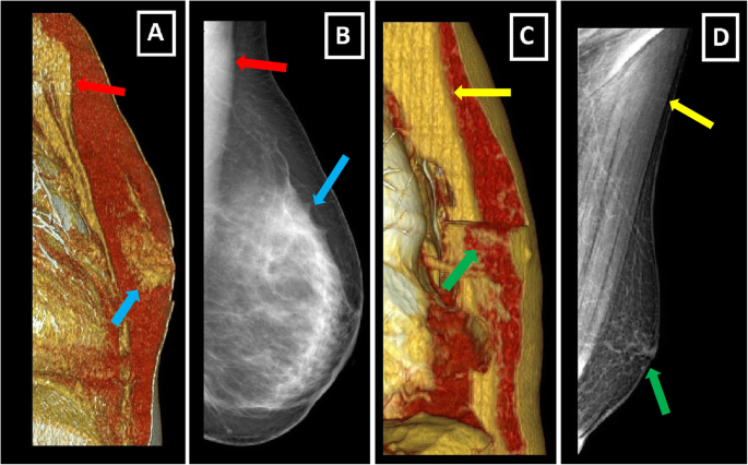Breast anatomy: fibroglandular and fat tissues, which have