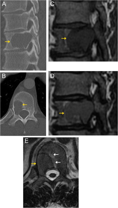 X Ray Dorso-lumbar Spine Lateral View shows bridging os