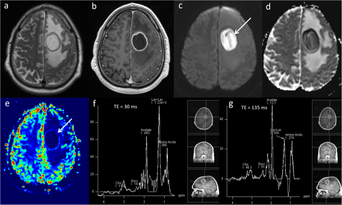 Case 31-1991 — A 67-Year-Old Man with Cerebral Lesions with Ring Enhancement  Demonstrable on a CT Scan Three Months after a Myocardial Infarct | NEJM