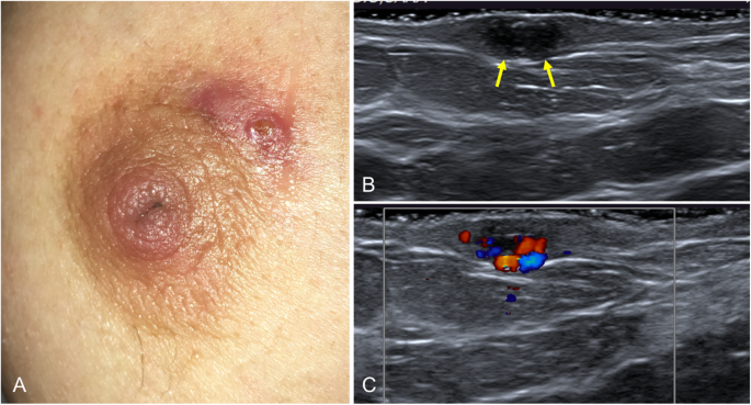 Multimodality approach to the nipple-areolar complex: a pictorial review  and diagnostic algorithm, Insights into Imaging