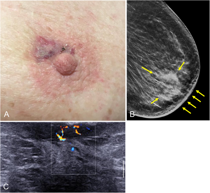 Multimodality approach to the nipple-areolar complex: a pictorial review  and diagnostic algorithm, Insights into Imaging