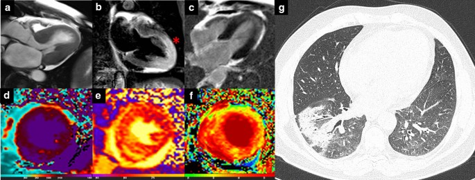 Spectrum of Cardiac Manifestations in COVID-19