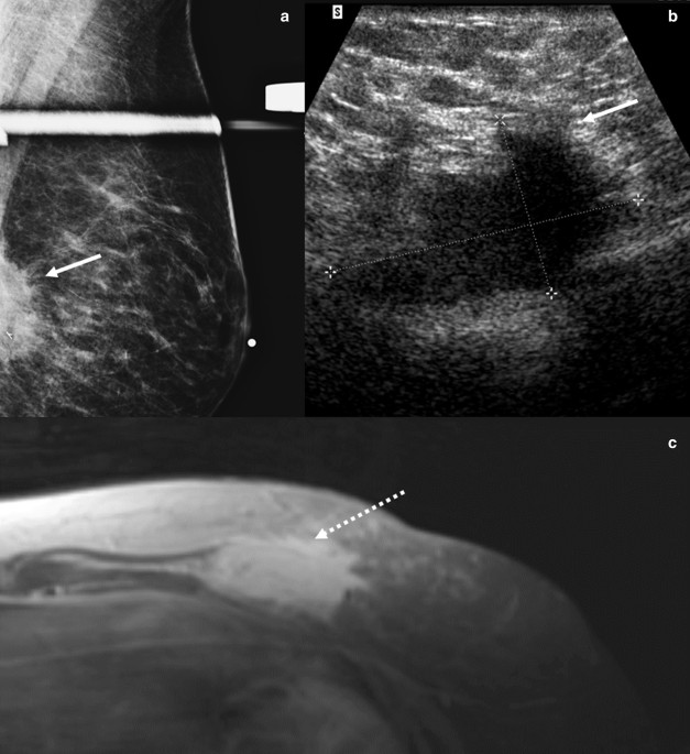 A 32-year-old woman with right breast scar from surgery of cyst