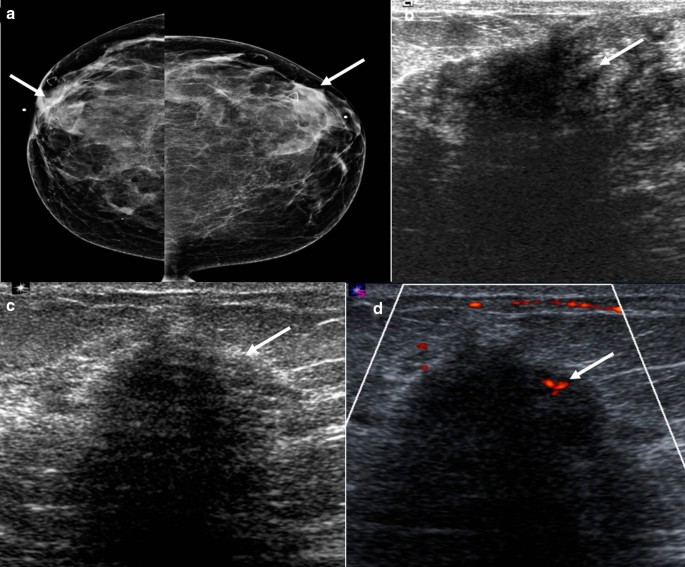 Breast mammogram showed bilateral benign gynecomastia, with the