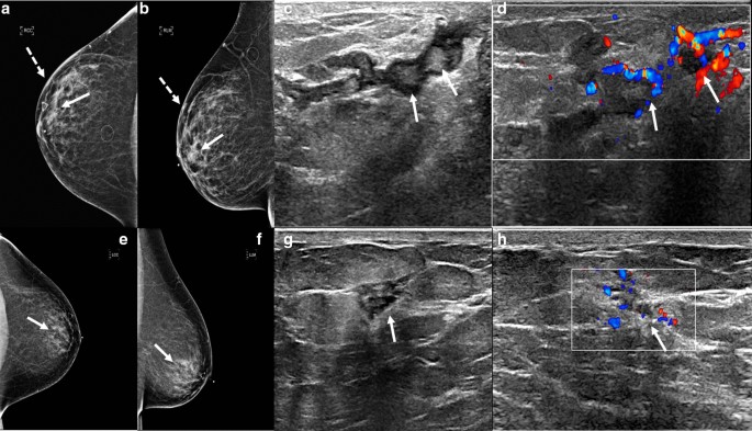 Mimickers of breast malignancy: imaging findings, pathologic