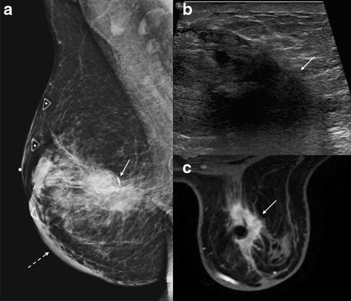 A 52-year-old woman presented for a bilateral screening mammogram