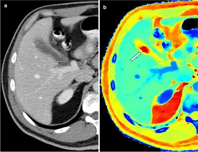 Spectral CT of the abdomen: Where are we now? | Insights into Imaging |  Full Text