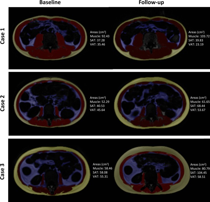 Body Composition — Inland Imaging