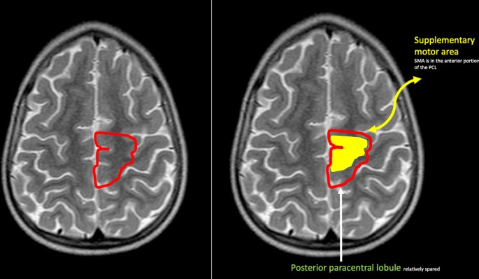 A proposed magnetic resonance imaging grading system for the spectrum of  central neonatal parasagittal hypoxic–ischaemic brain injury | Insights  into Imaging | Full Text