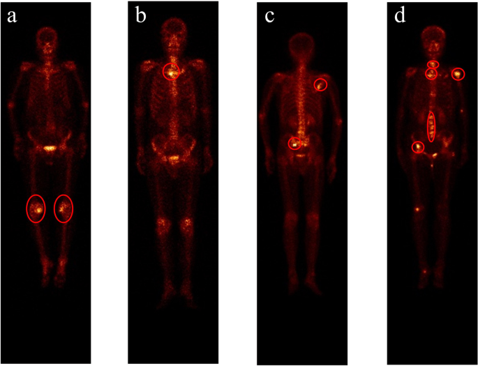 Leveraging Datature Nexus for Tumor and Anomaly Detection in Medical Scans  : Part I