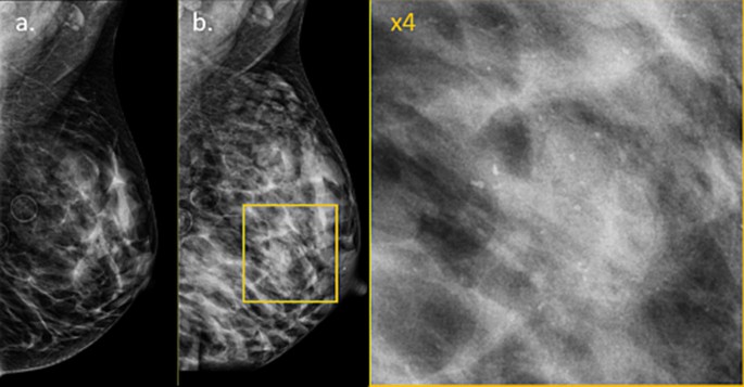 Figure 1 from Breast disorders in pregnant and lactating women.