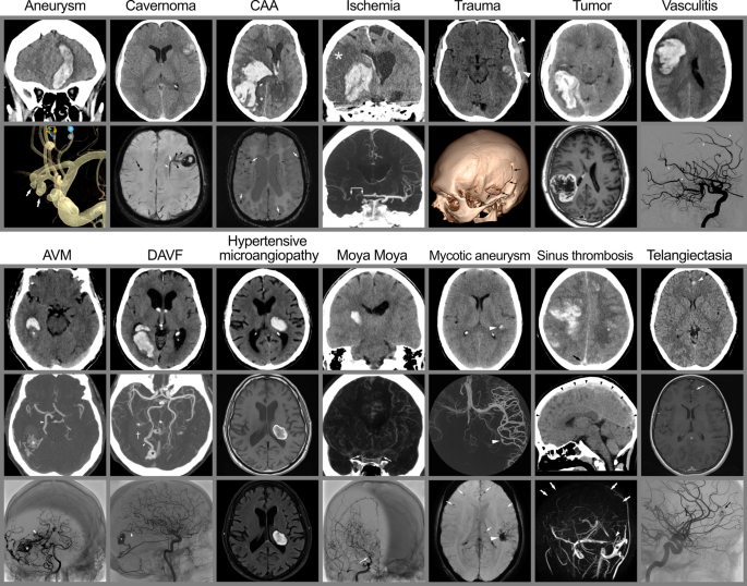 Magnetic resonance imaging. Large intracranial hemorrhage with moderate