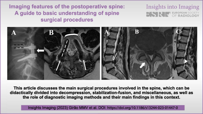 Imaging features of the postoperative spine: a guide to basic
