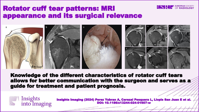 Rotator cuff tear patterns: MRI appearance and its surgical relevance, Insights into Imaging